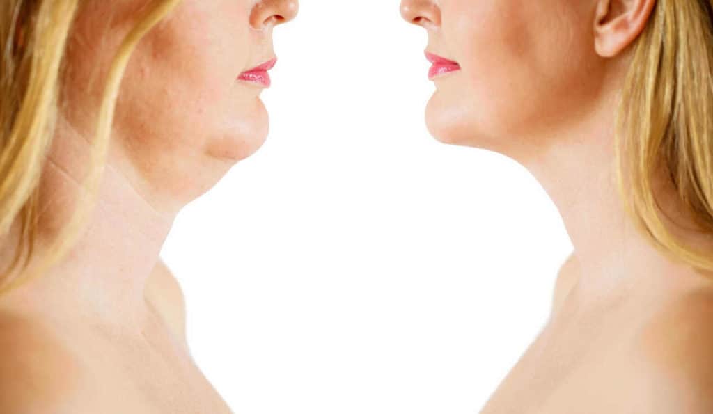 Double Chin treatment Telford before and after results