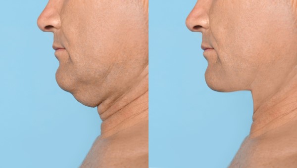 Which Non-Surgical Treatments Work Best for Jowls and Loose Skin Telford?