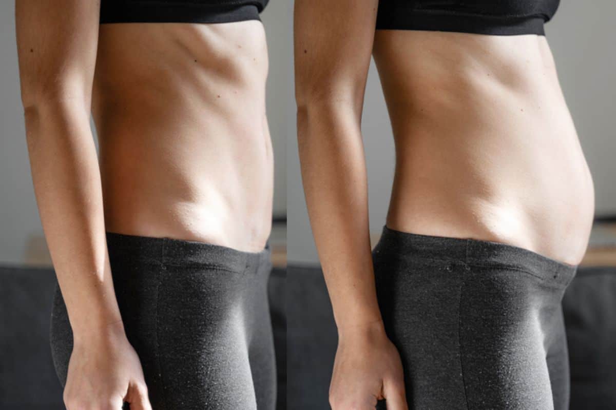 How long does diastasis recti take to improve Telford?