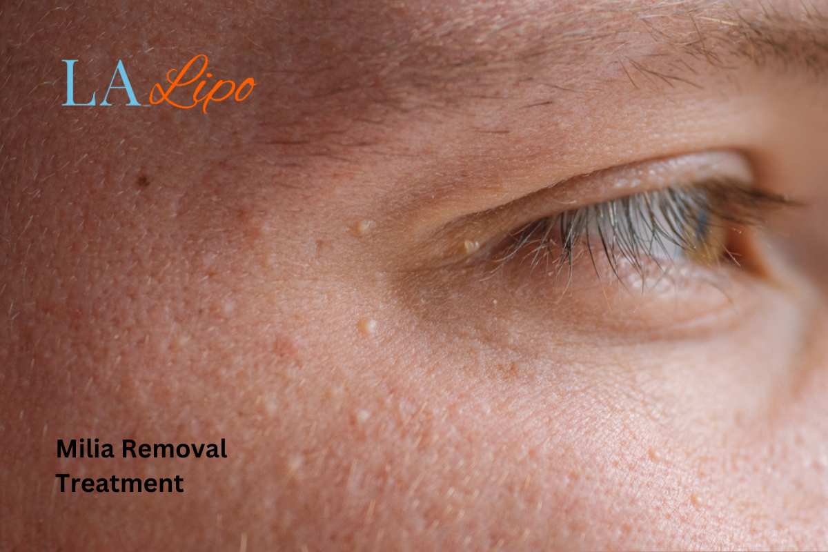 Cryopen Milia Removal: Is It the Easiest and Safest Option Telford?