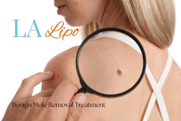 Why getting moles removed Telford can boost your confidence!