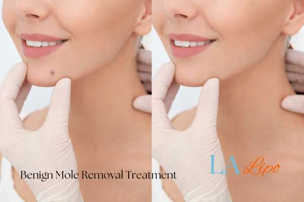 Woman's before and after results of being moles removal treatment Telford