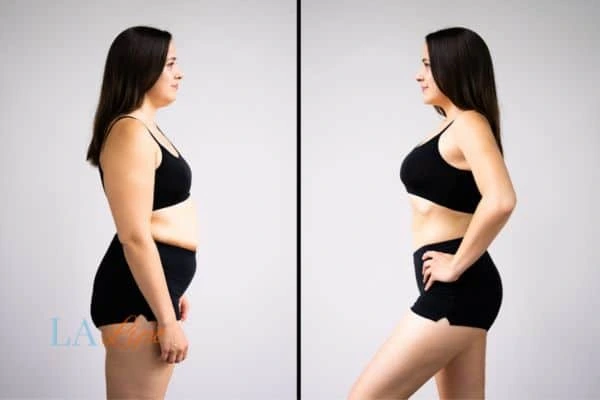 image of woman before and after results of LA-EMS Body Sculpting Telford to help treat Diastasis recti