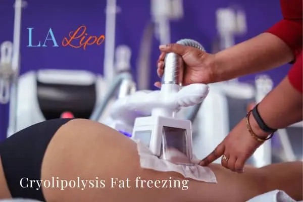 women getting fat freezing Telford