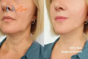 hi-fu for wrinkles Telford before and after results