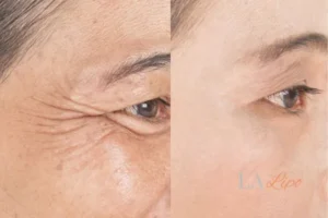 Before and after results of woman - HI-fu wrinkles reduction treatment Telford