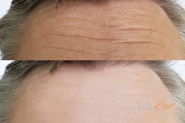 results of HIFU Telford on mans forehead to help reduce lines and wrinkles
