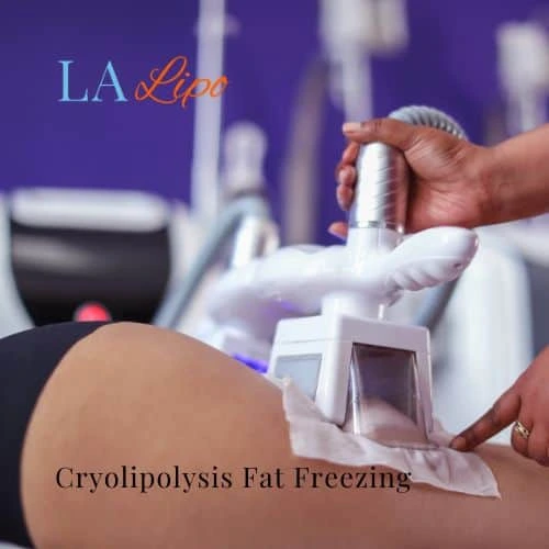 fat freezing - Cryolipolysis Telford