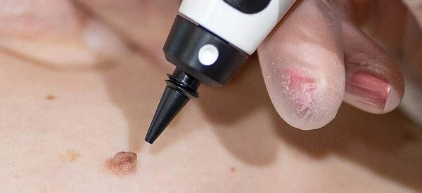 skin tag removal using cryopen Telford