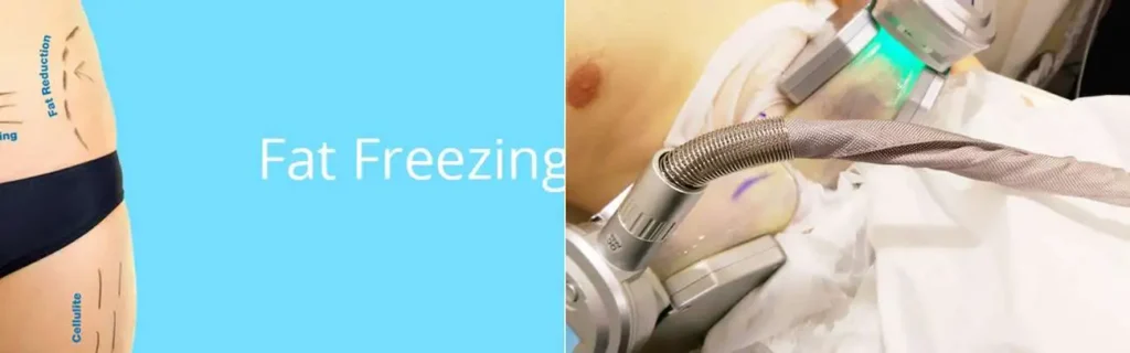 multi areas of a persons body having coolsculpting Telford treatment