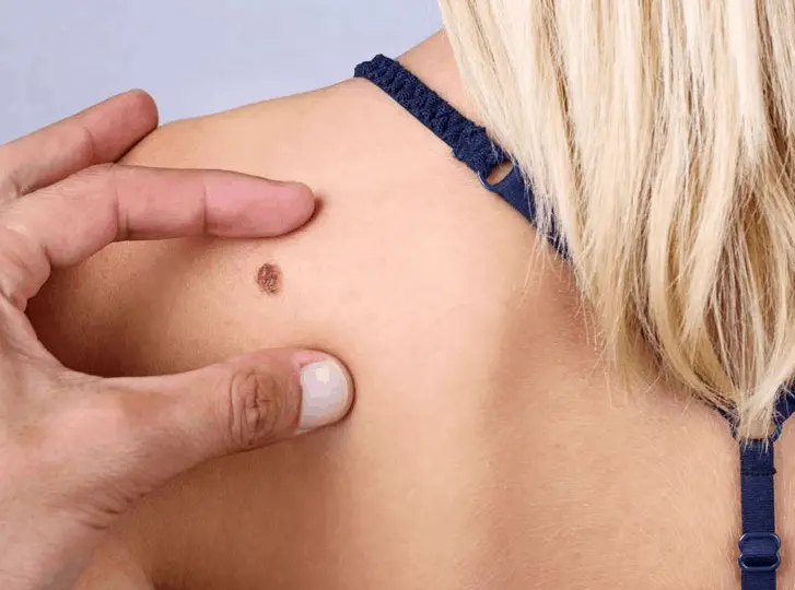 woman having mole removal Telford consultation before treatment.
