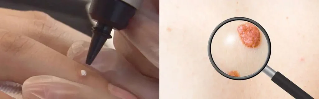 Cryopen for mole removal Telford - speak to our team today!