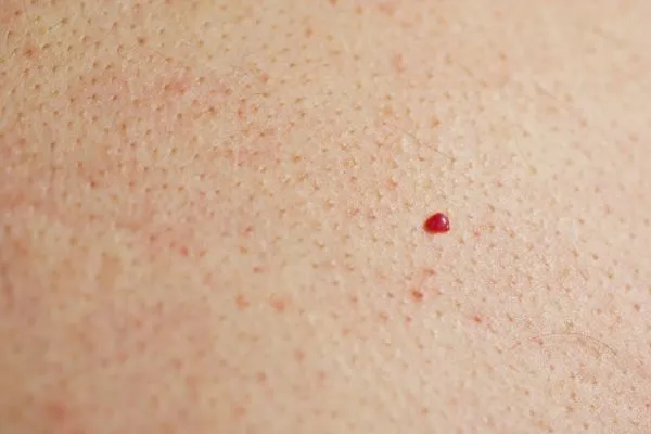 close up of a cherry angioma Telford