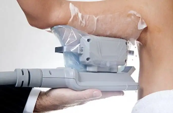Picture of fat freezing Telford on the upper arms.