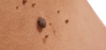 image of a skin tag Telford