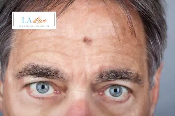 Solar Lentigo Removal Telford image of man with mark on his forehead