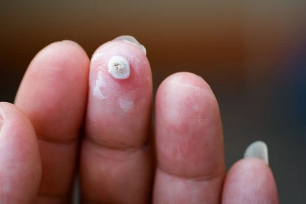 wart on person finger - cryotherapy to treat from LA LIPO Telford