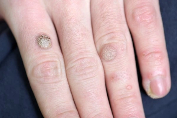 photo of warts on person hand - see wart removal Telford from LA LIPO