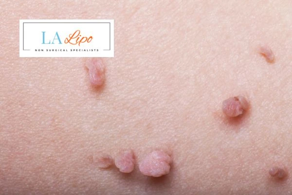 Does cryopen skin tag removal Telford hurt? Find out now call our team today!