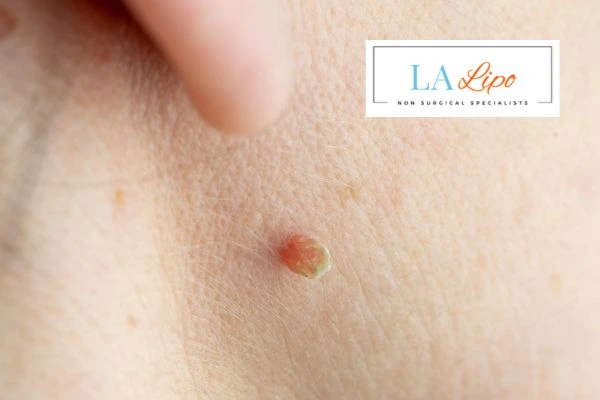 Book skin tag removal Telford today speak to our team now!