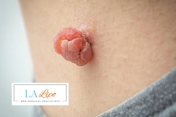 Interested in skin tag removal Telford? Concerned about the pain? Find out more today!