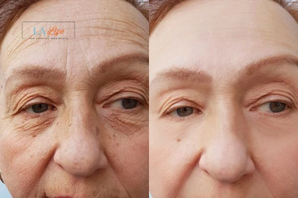 The powerful benefits of Morpheus8 Treatment Telford - Call Our team today!