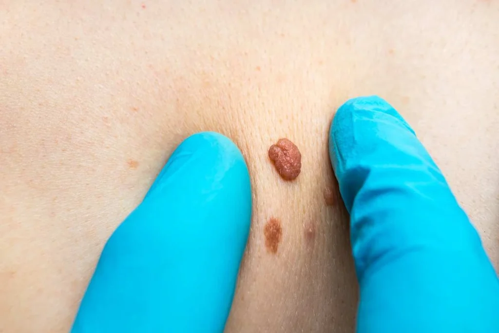 LA LIPO Cryopen Lesion Removal Prices Telford
