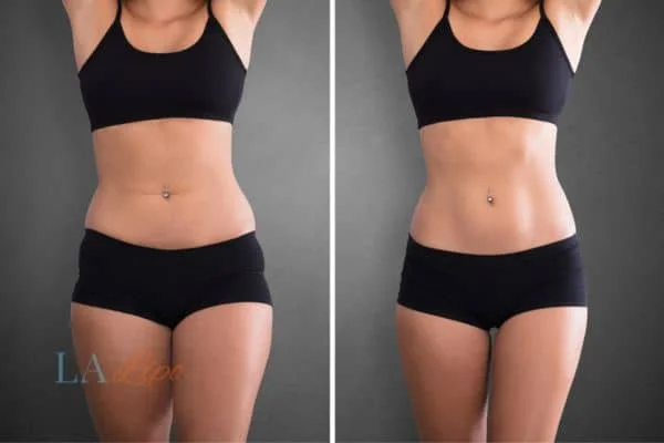 before and after results of non-surgical treatment to help a woman's body image and mental health Telford