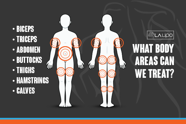 Diagram to show areas you can have LA-EMS Body Sculpting Treatment Telford