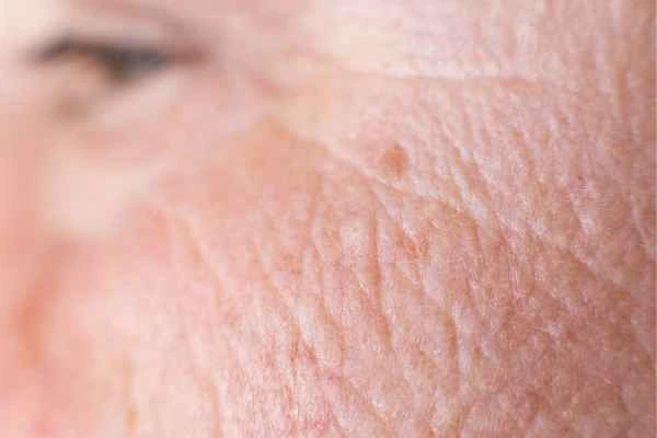 close up picture of a woman's face showing an age spot Telford