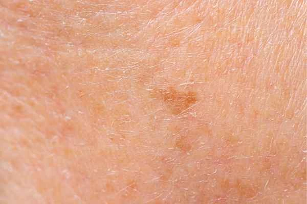close up picture of age spots Telford