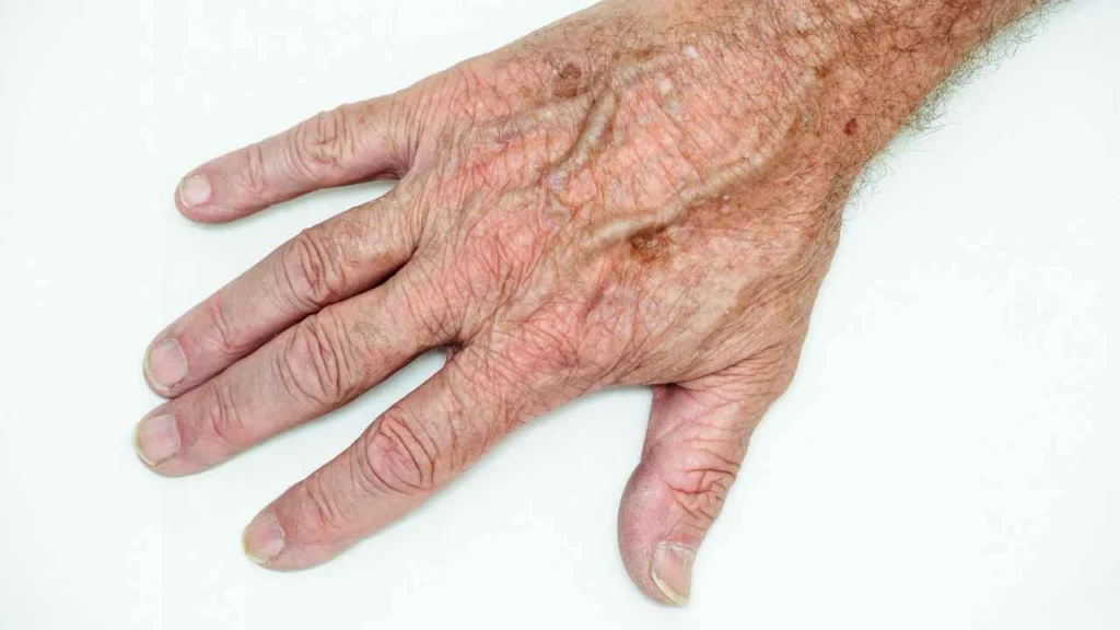 Male hand showing age spot Telford