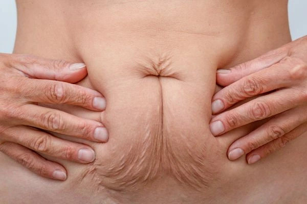 Image of a woman's stomach with loose skin - example of skin tightening Telford options