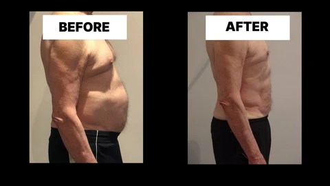 What Symptoms Can Diastasis Recti Cause in Men? Weak Core, Back Pain and Poor Posture Telford